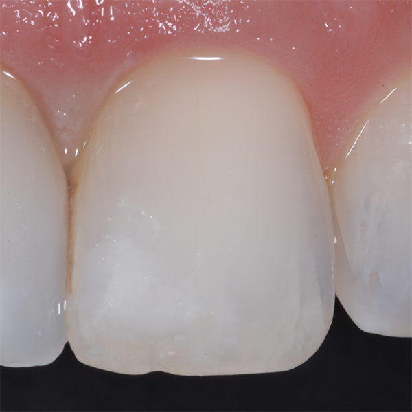Tooth 1